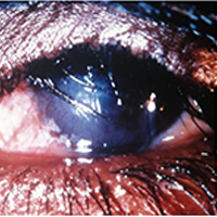 eye with blinding trachoma